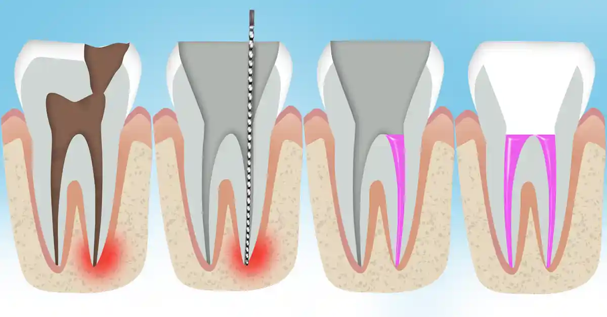 rotfylling av tann illustrasjon