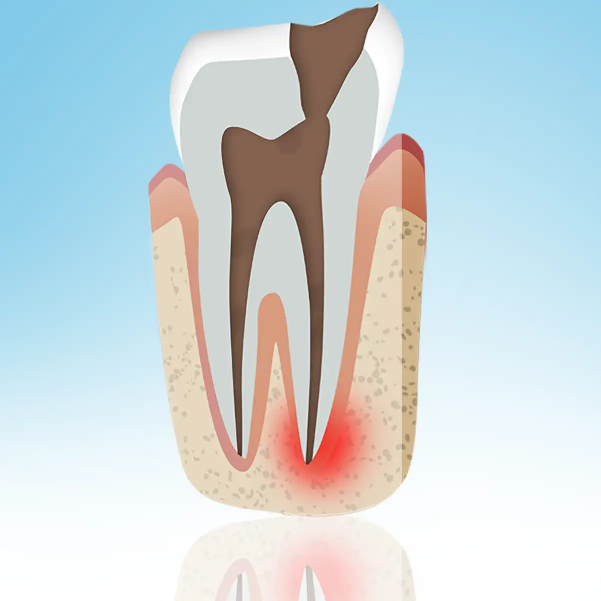 rotfylling illustrasjon hull i tann