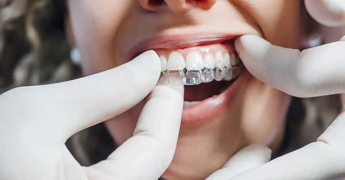 invisalign tannregulering pa tennene