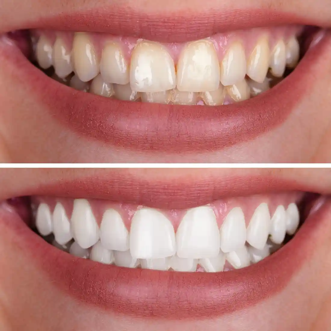 tannbleking eksempel hvite tenner
